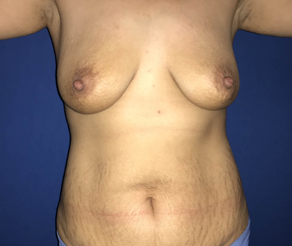 Abdominoplasty case #119573