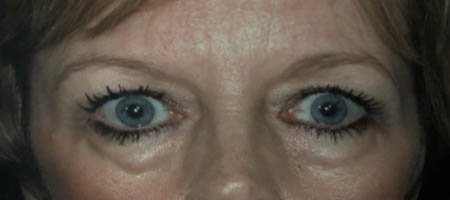 Blepharoplasty case #119732