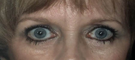 Blepharoplasty case #119732