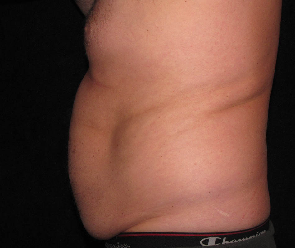 Men's Liposuction case #119665