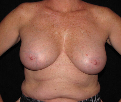 Breast Augmentation case #119609