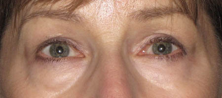 Blepharoplasty case #119735