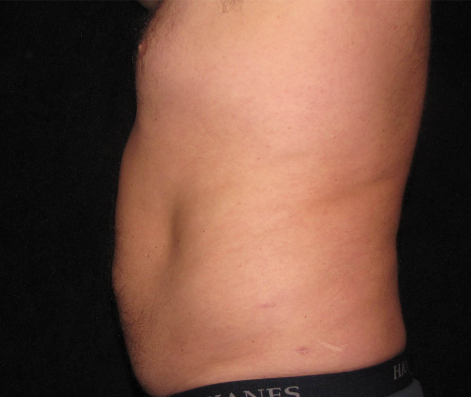 Men's Liposuction case #119665