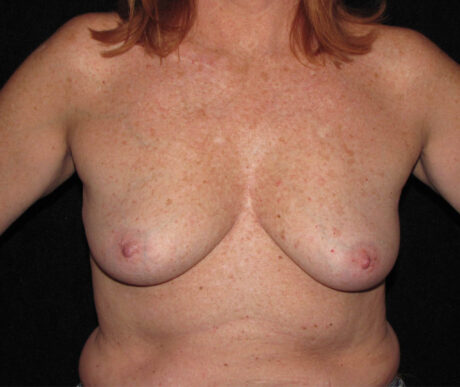 Breast Augmentation case #119609