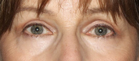 Blepharoplasty case #119735