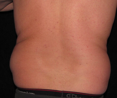 Men's Liposuction case #119665