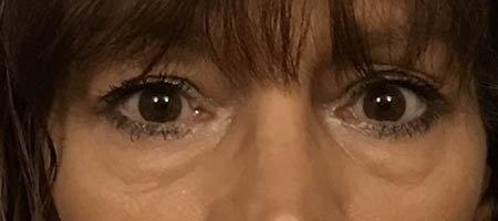 Blepharoplasty case #119738