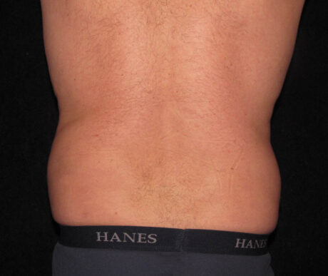 Men's Liposuction case #119665