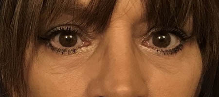 Blepharoplasty case #119738