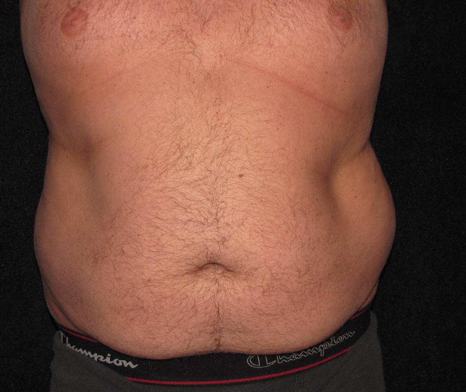 Men's Liposuction case #119665