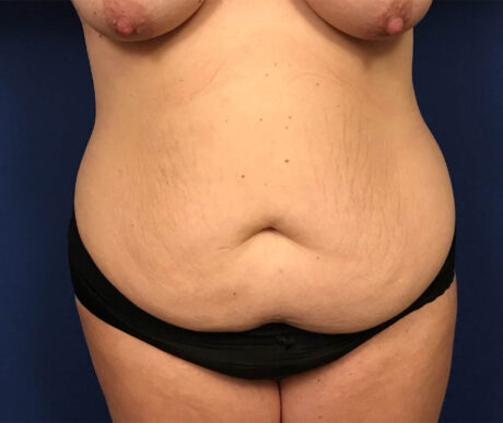 Abdominoplasty case #119630