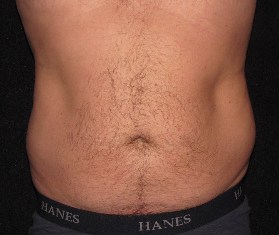 Men's Liposuction case #119665