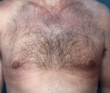 Gynecomastia case #119681