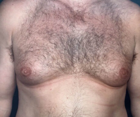 Gynecomastia case #119681