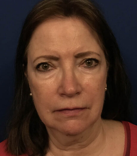 Face & Neck Lift case #119793