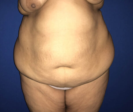 Abdominoplasty case #119627