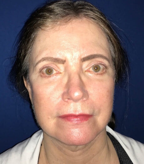 Face & Neck Lift case #119793