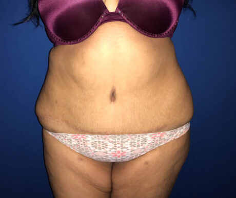 Abdominoplasty case #119627