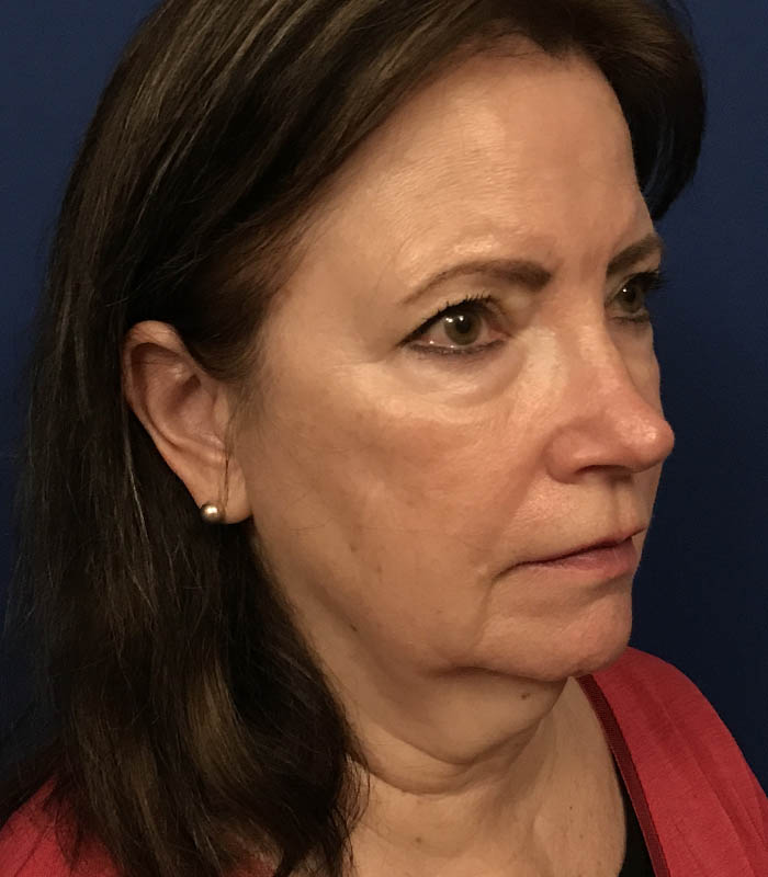 Face & Neck Lift case #119793