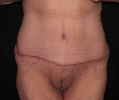 Abdominoplasty case #119618