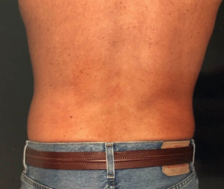 Men's Liposuction case #119642