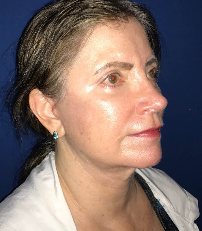 Face & Neck Lift case #119793