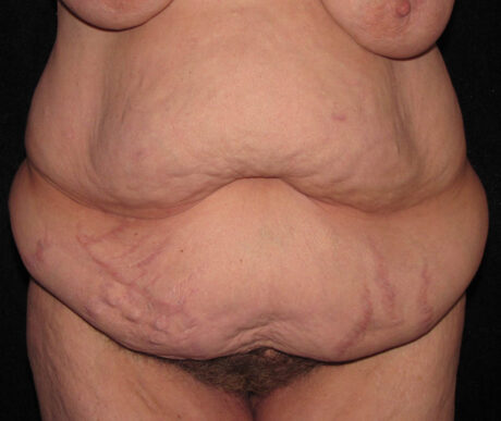 Abdominoplasty case #119618