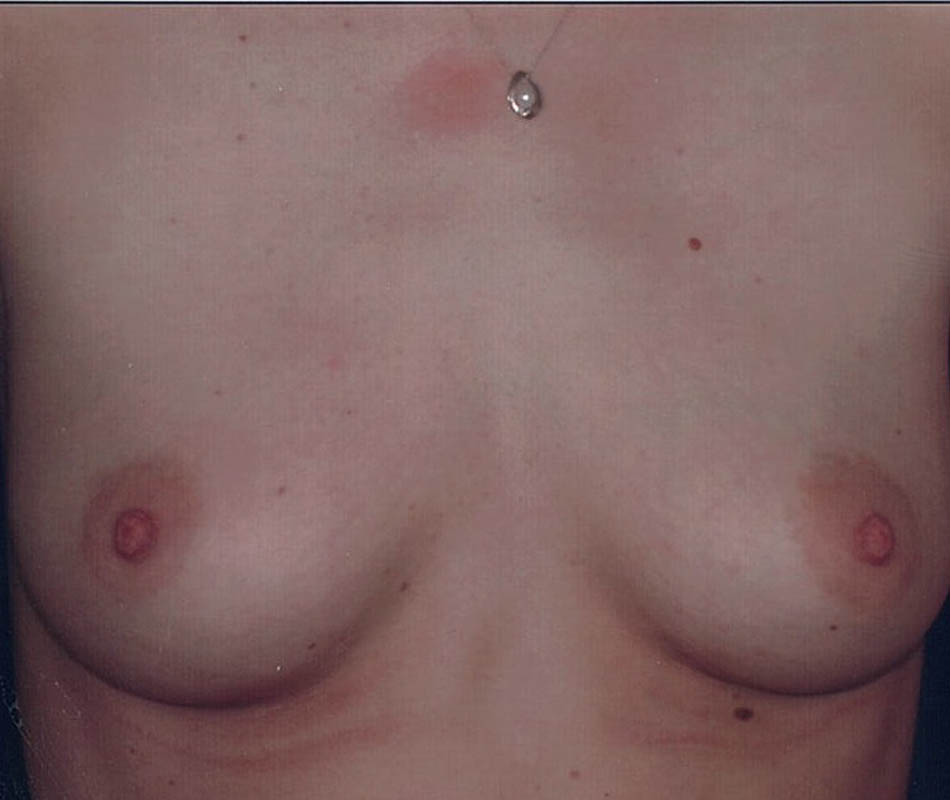 Breast Augmentation case #119594