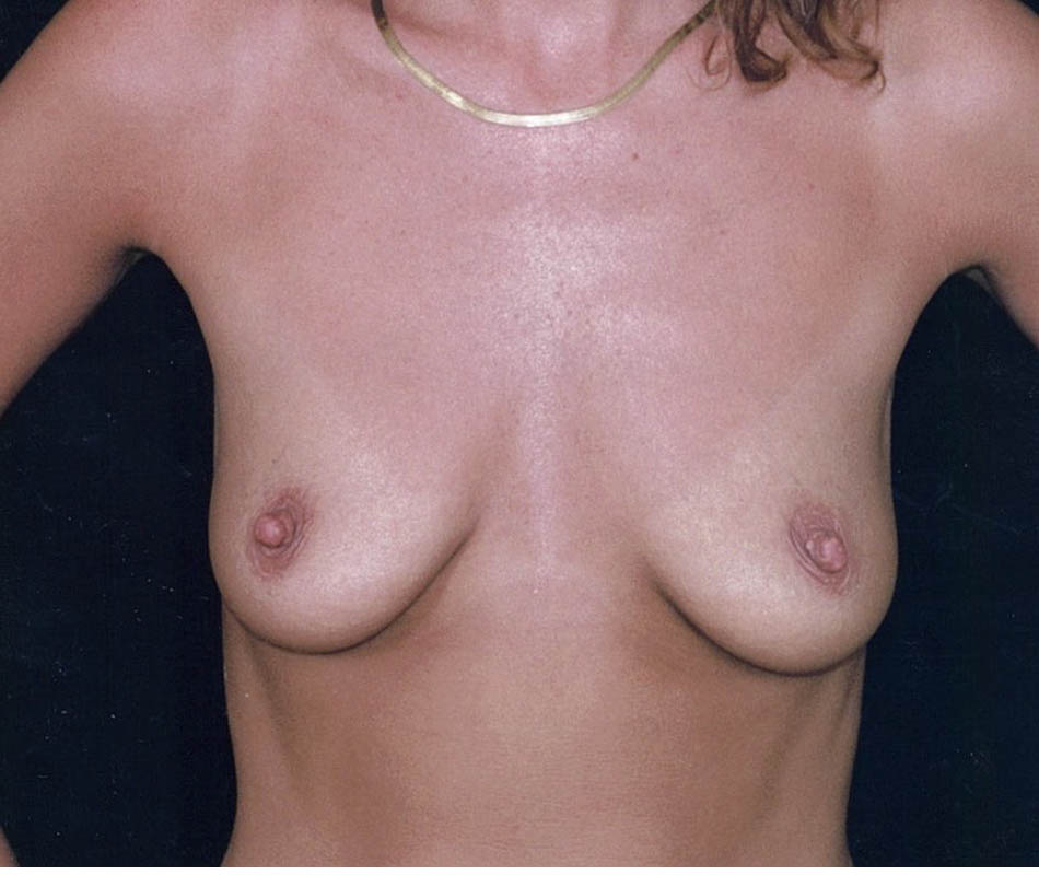 Breast Augmentation case #119588