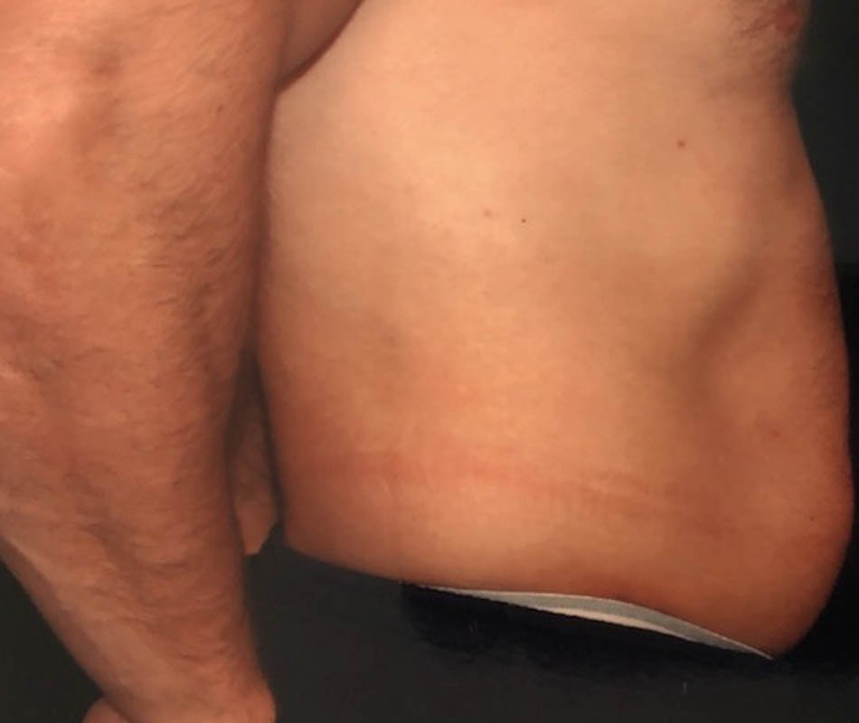 Men's Liposuction case #119651