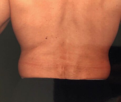 Men's Liposuction case #119651