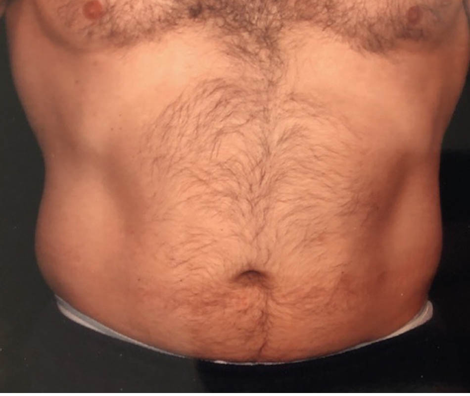 Men's Liposuction case #119651