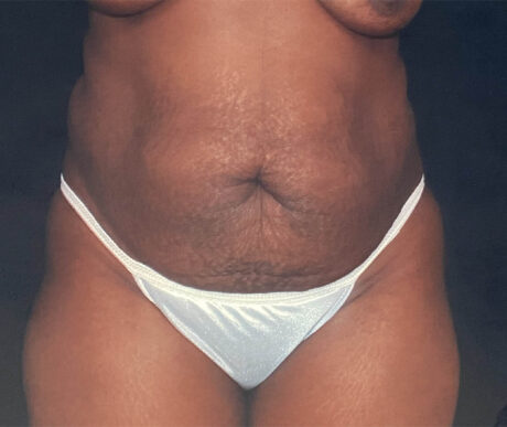 Abdominoplasty case #119621