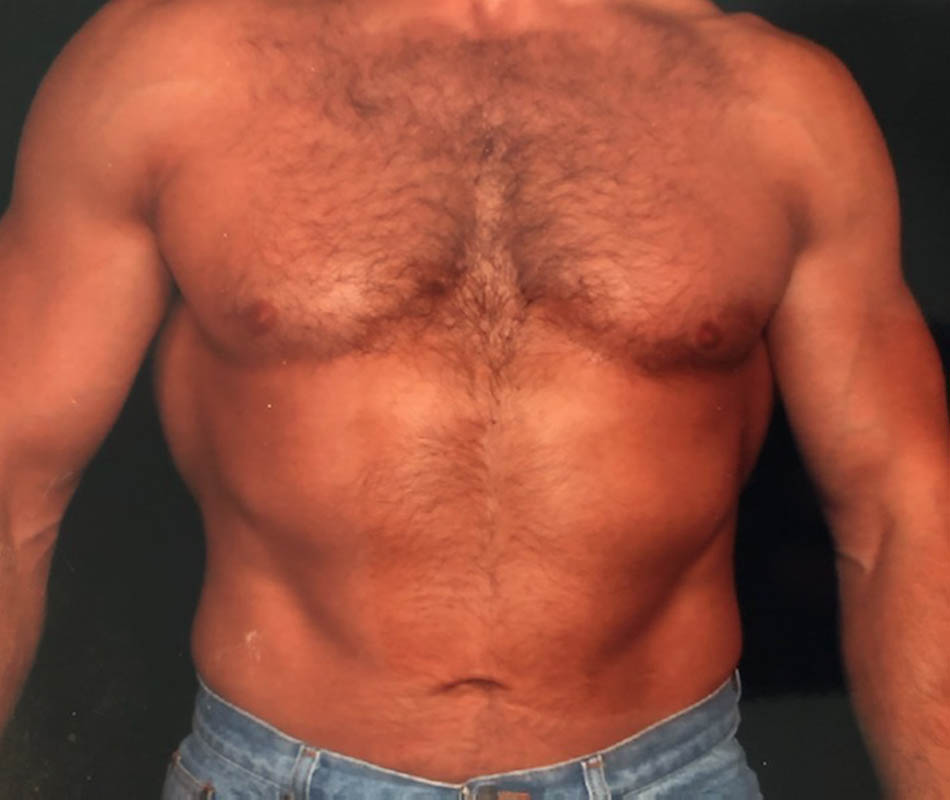 Men's Liposuction case #119651