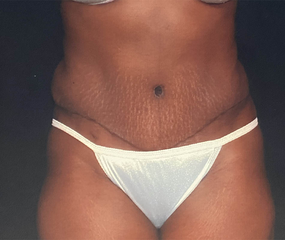 Abdominoplasty case #119621