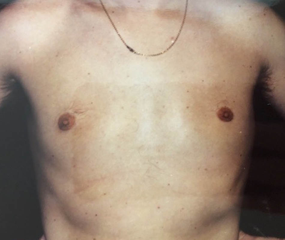 Gynecomastia case #119675