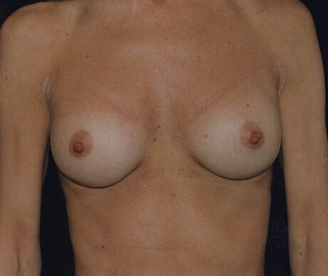 Breast Augmentation case #119597