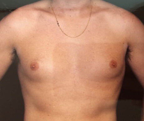 Gynecomastia case #119675