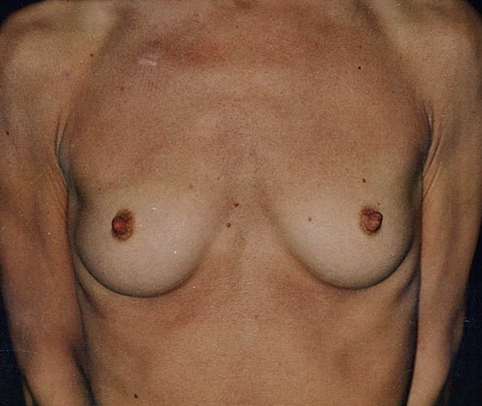 Breast Augmentation case #119597