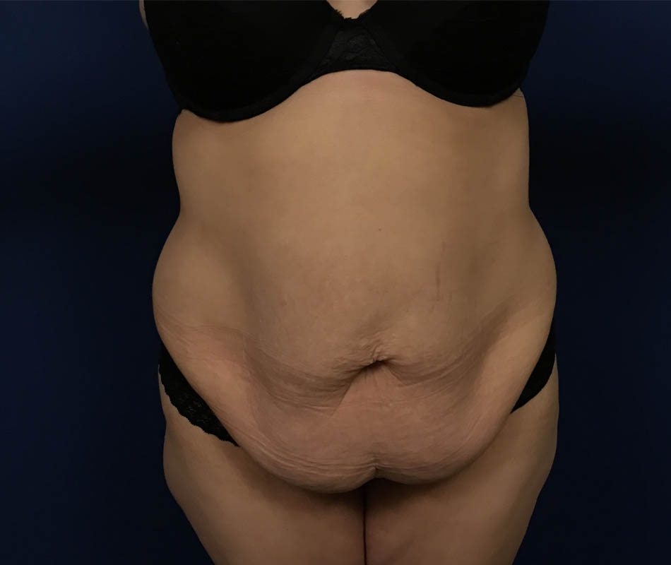 Abdominoplasty case #119615