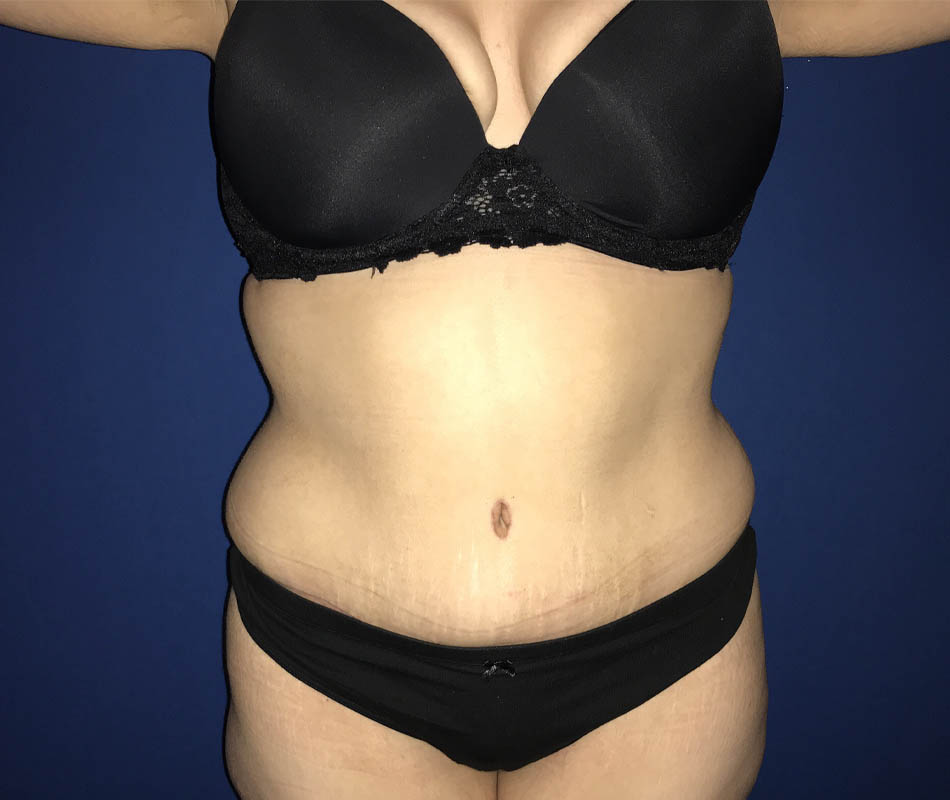 Abdominoplasty case #119615