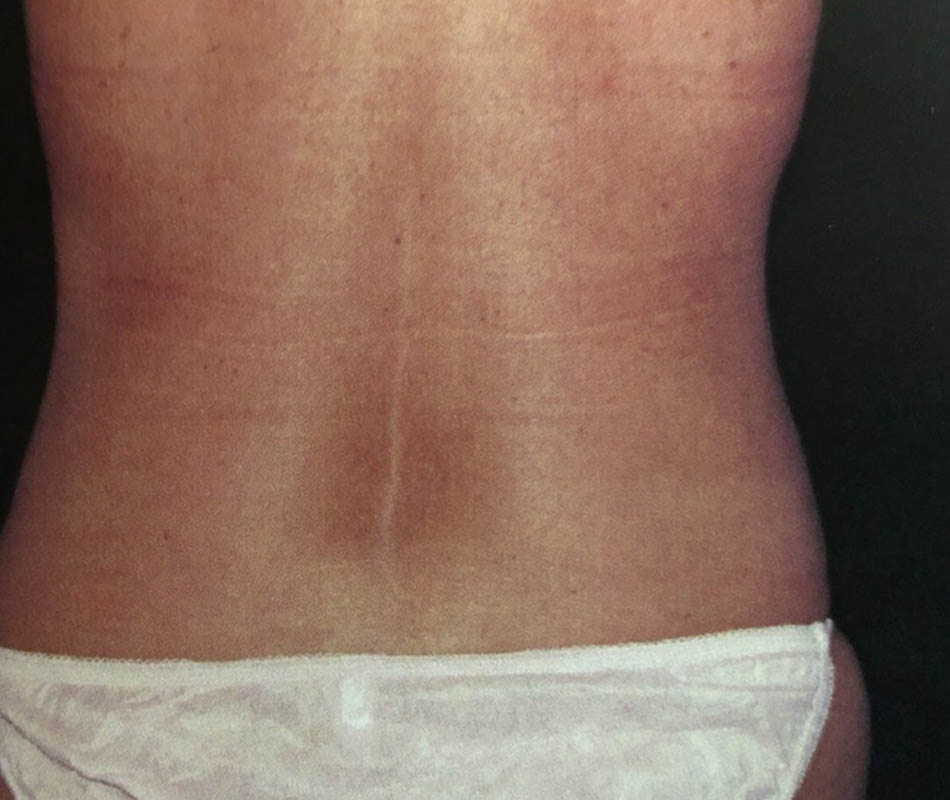 Liposuction case #119645