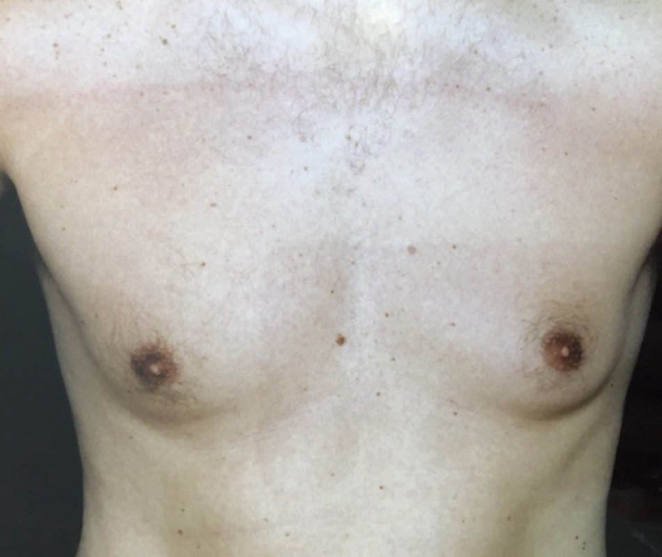 Gynecomastia case #119678