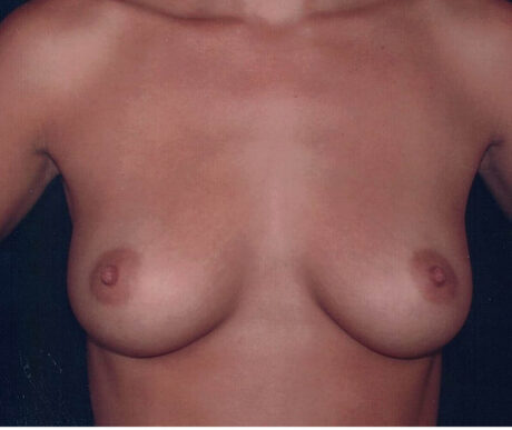 Breast Augmentation case #119603