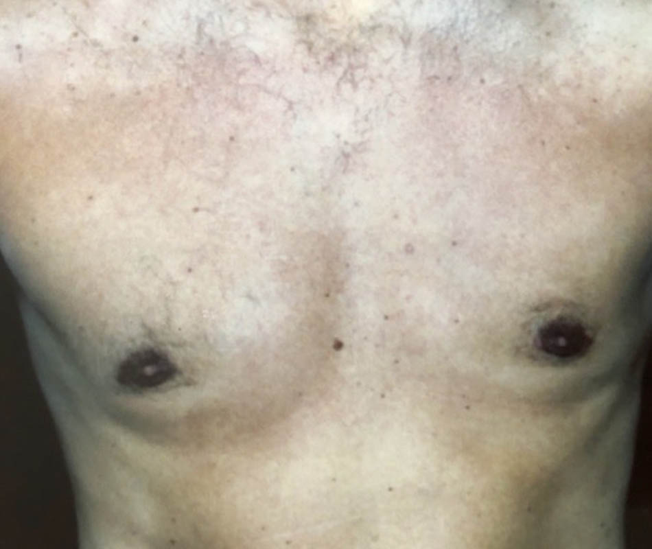 Gynecomastia case #119678