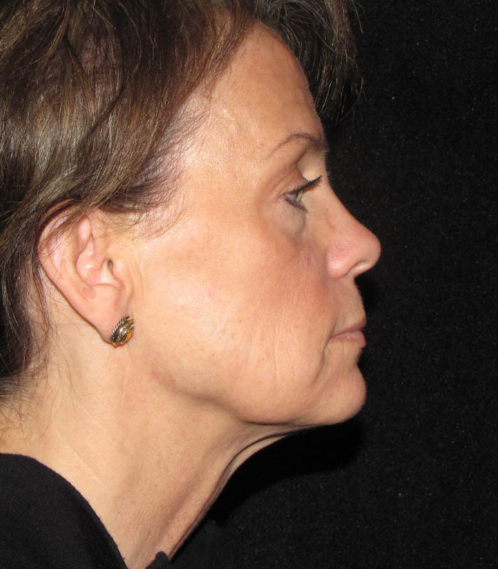 Face & Neck Lift case #119800