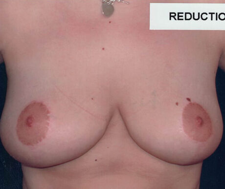 Breast Reduction case #119687