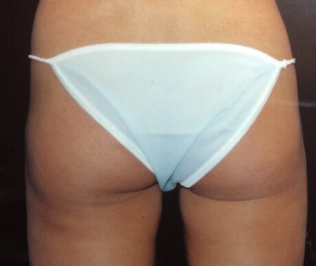 Liposuction case #119648