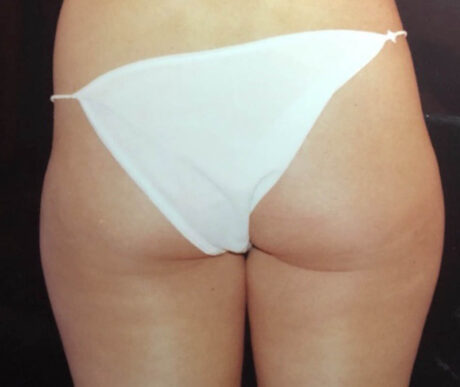 Liposuction case #119648