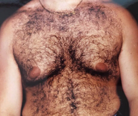 Gynecomastia case #119672